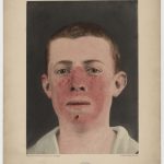 Malade atteint de « xeroderma pigmentosum », photographie aquarellée de Félix Méheux, vers 1889. Cette maladie, qui touche les « enfants de la lune », se caractérise par une sensibilité extrême de la peau et des yeux au soleil.